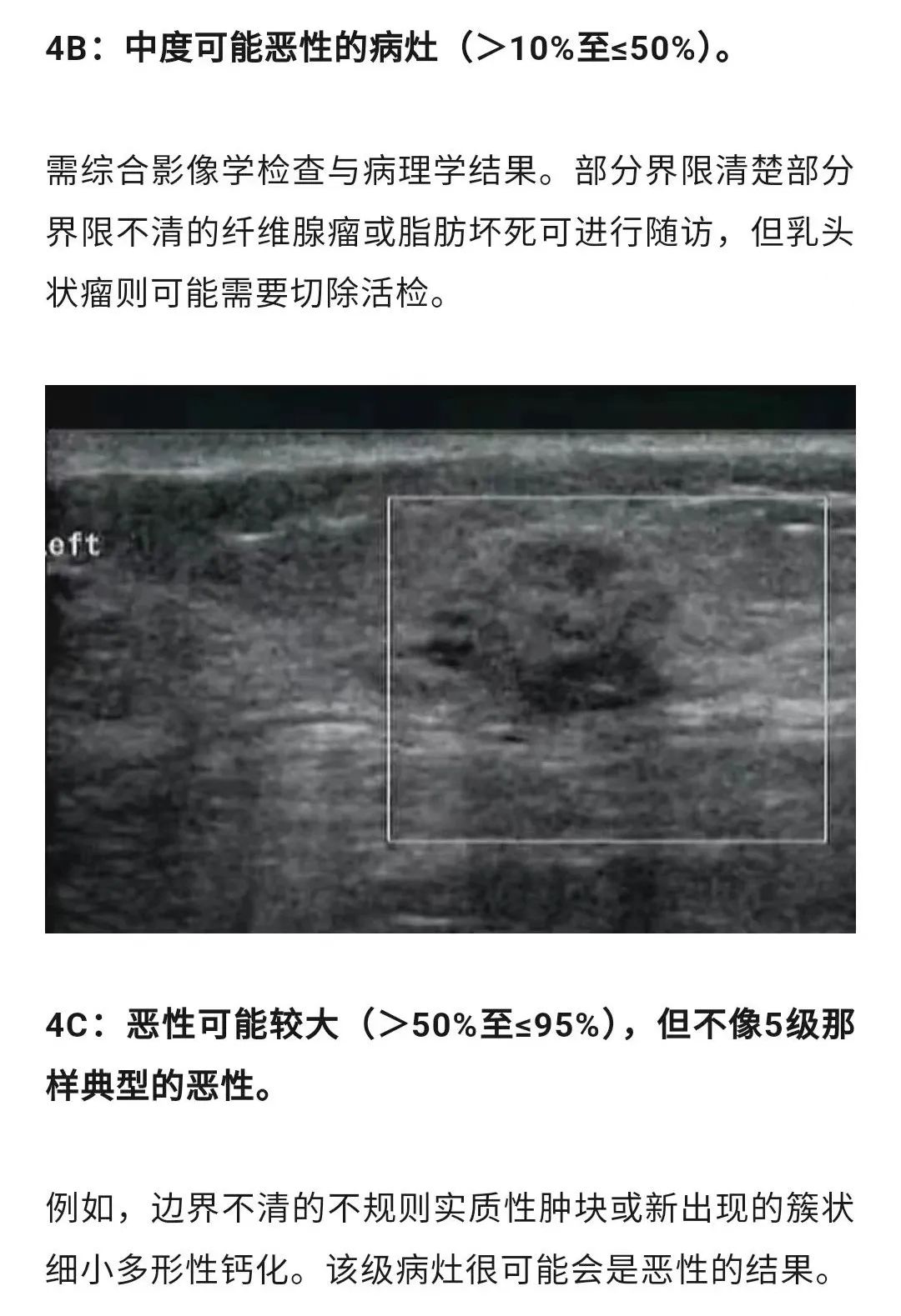 乳腺結(jié)節(jié)惡性的可能性有多大？一文讀懂乳腺結(jié)節(jié)BI-RADS分級(jí)標(biāo)準(zhǔn)！